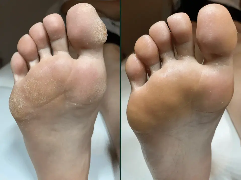 Pedicure frezarkowy - jak wygląda, ile trwa i kiedy go wybrać